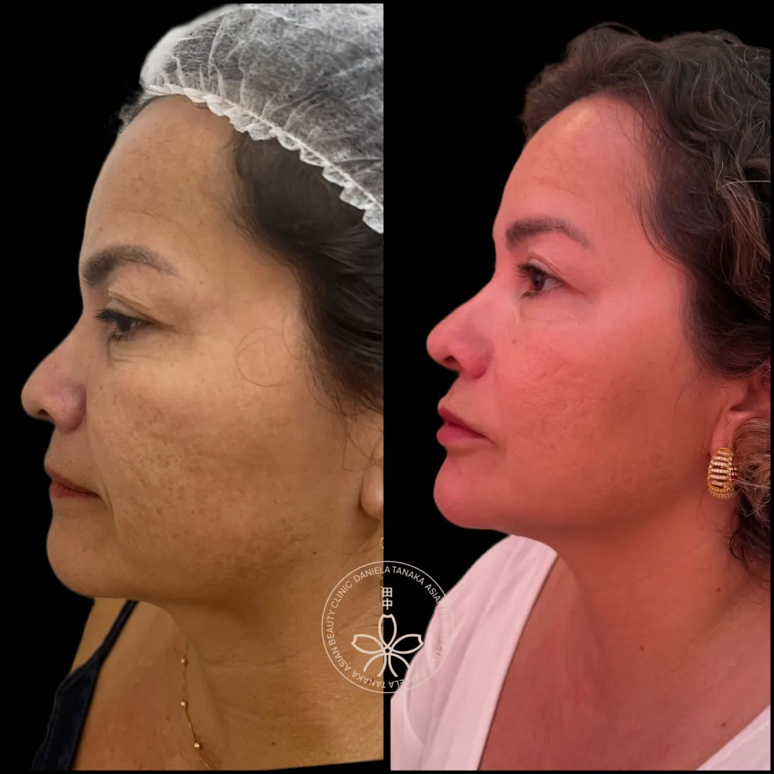 Harmonização Facial, antes e depois