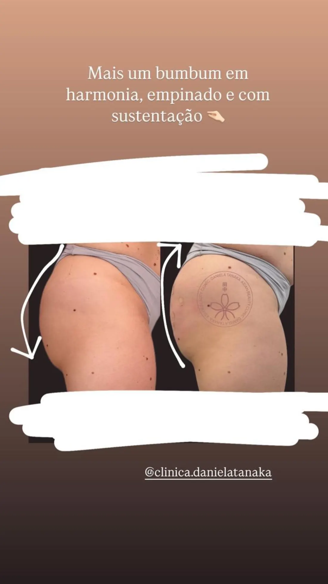 Tratamento Glúteo, antes e depois