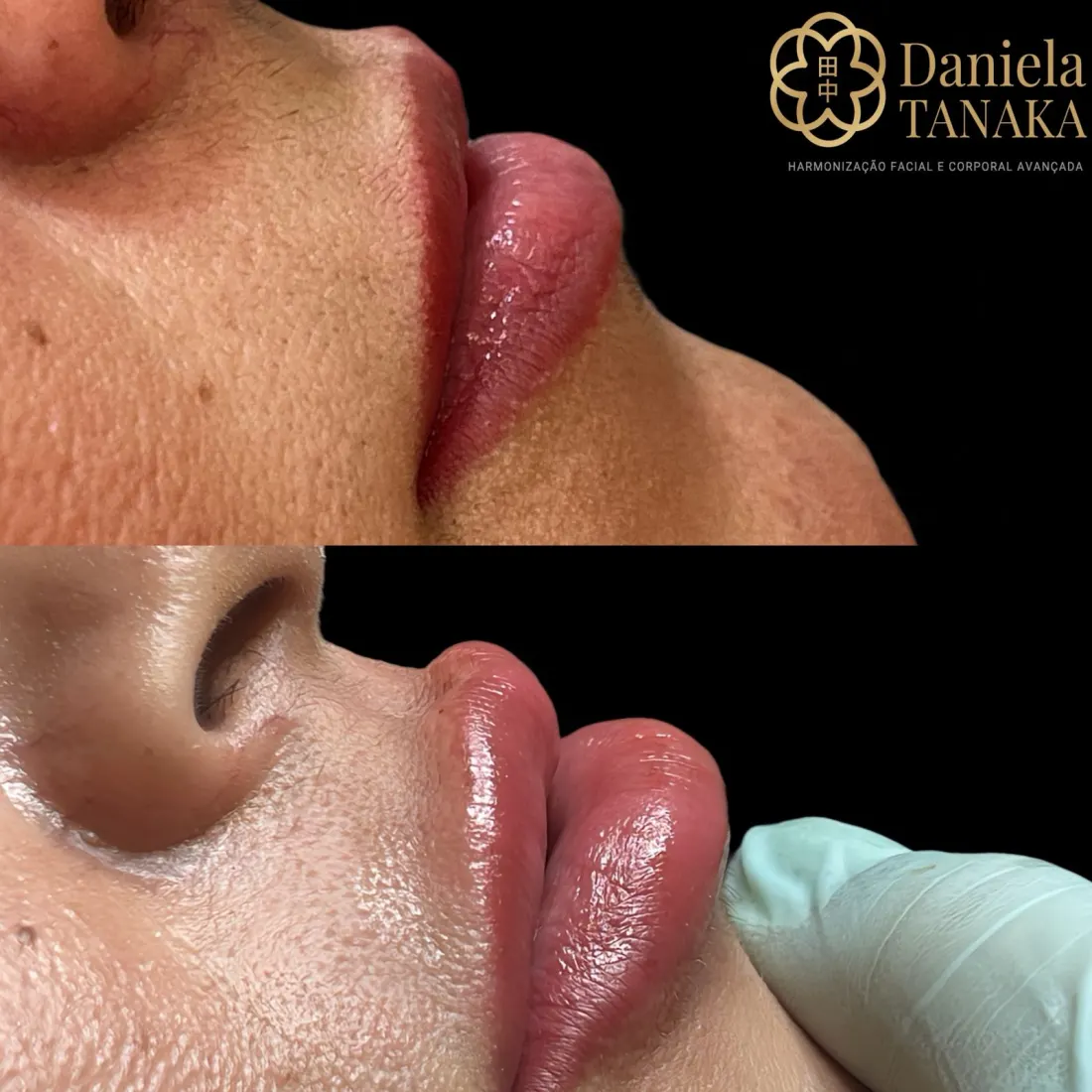 Preenchimento Labial, antes e depois