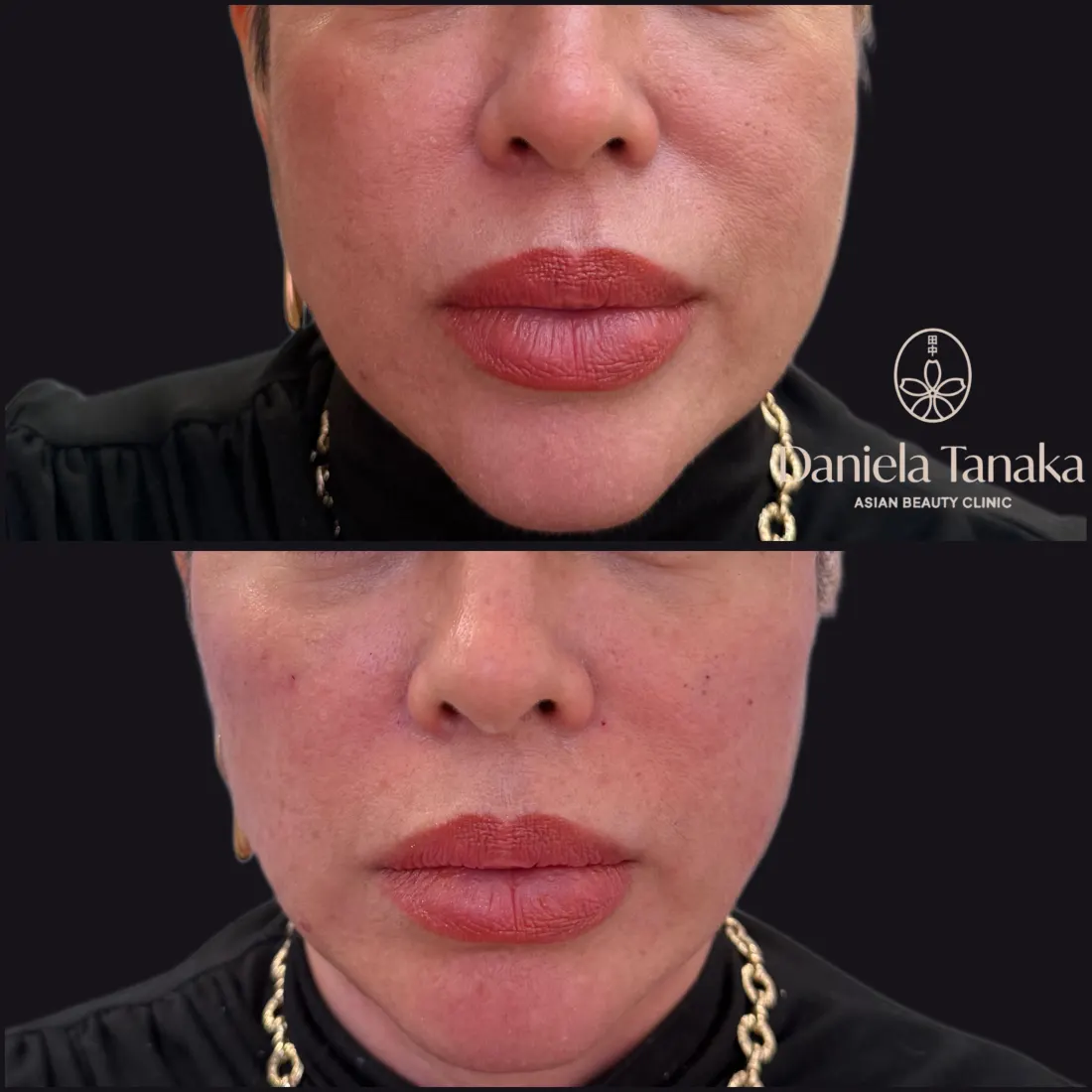Lábios, antes e depois