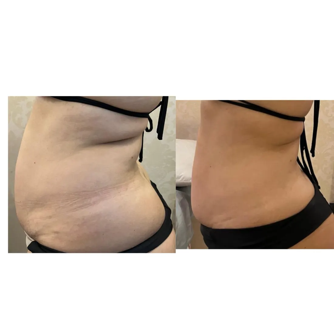 LipoCrio, antes e depois