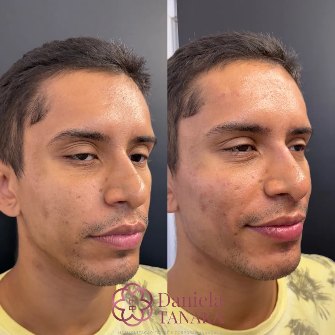 Harmonização Masculina, antes e depois