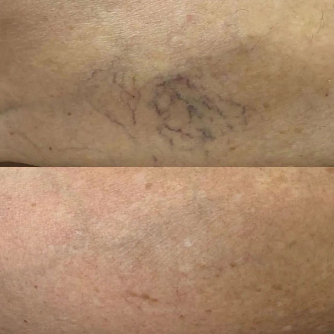 Tratamento de Microvasos, antes e depois
