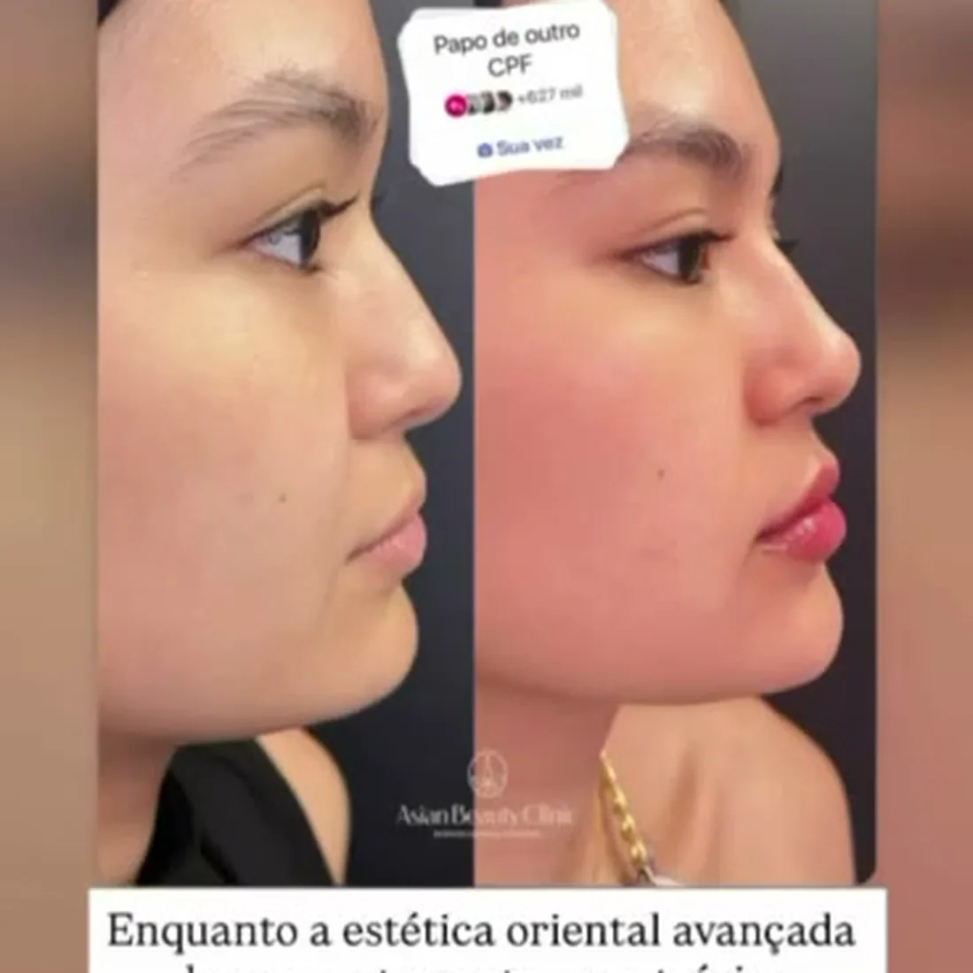 Vídeo antes e depois de harmonização de perfil