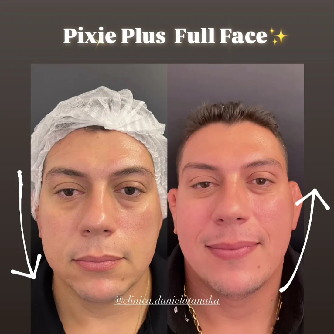 Vídeo antes e depois de Pixie Plus Full Face masculino